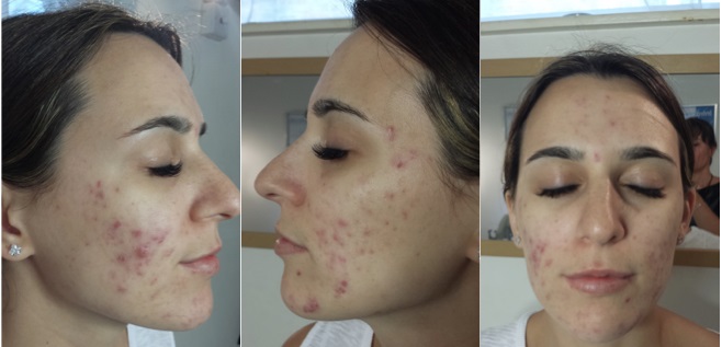 Acne Before Treatment